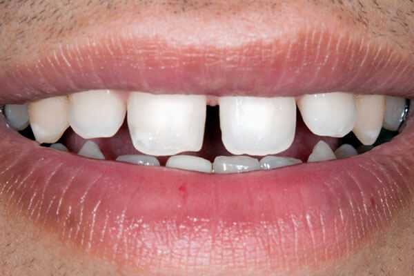 Gaps between Teeth Image