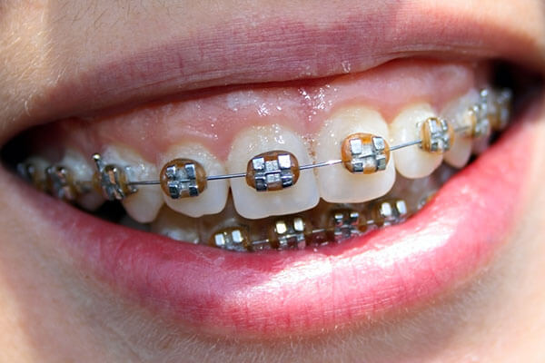 Overbite Image